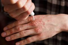 Psoriazisul, mai mult decât o boală de piele