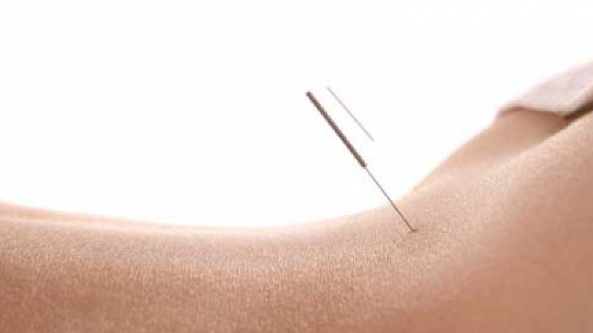 Spune NU celulitei cu acupunctură!