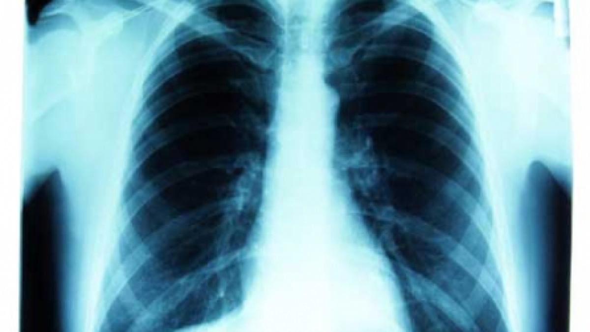 Ce ştim despre   pneumonii