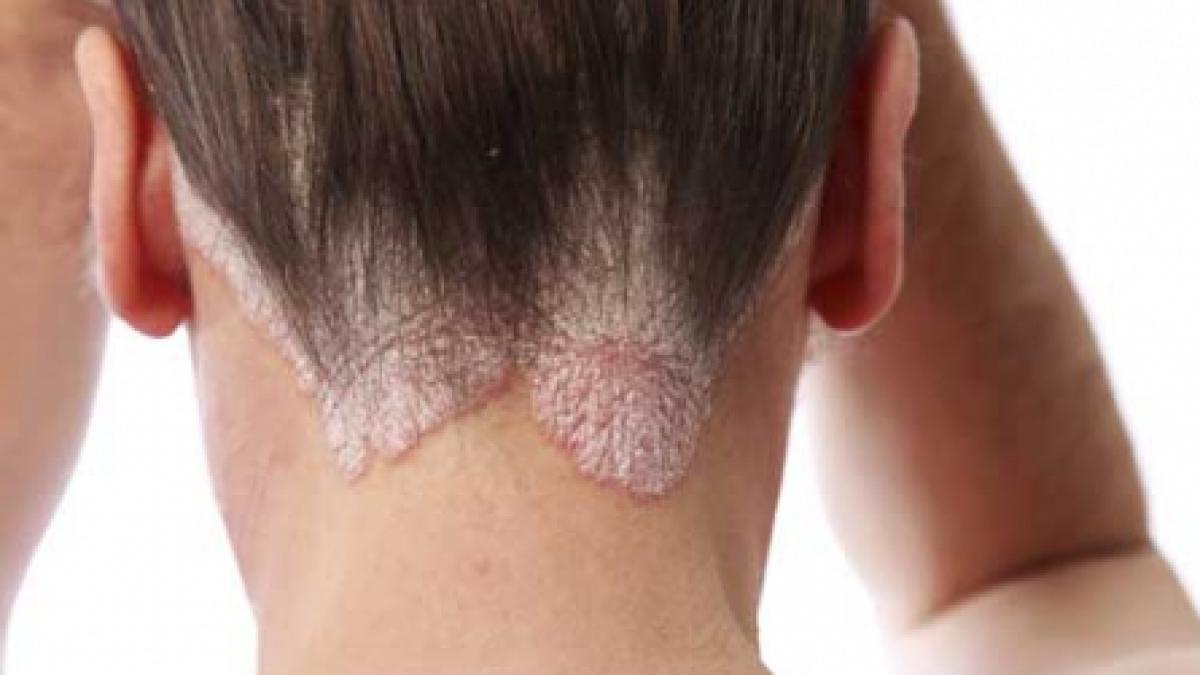 Psoriazisul vine brusc şi nu mai pleacă