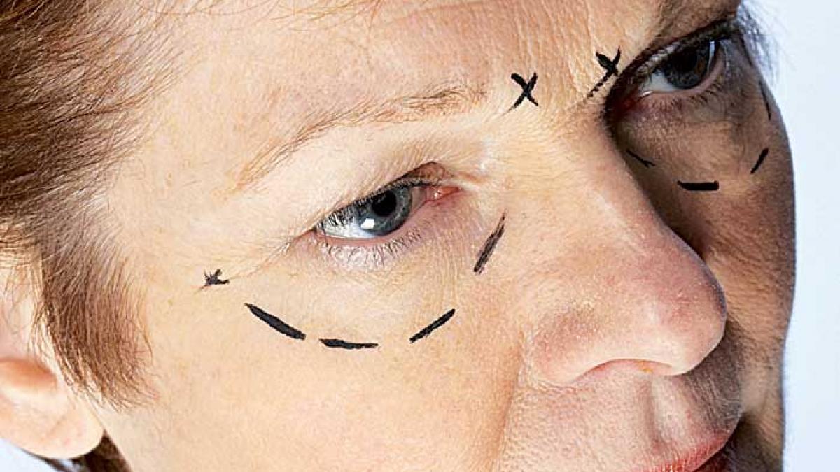 După 50 de ani, start la liftingul facial!