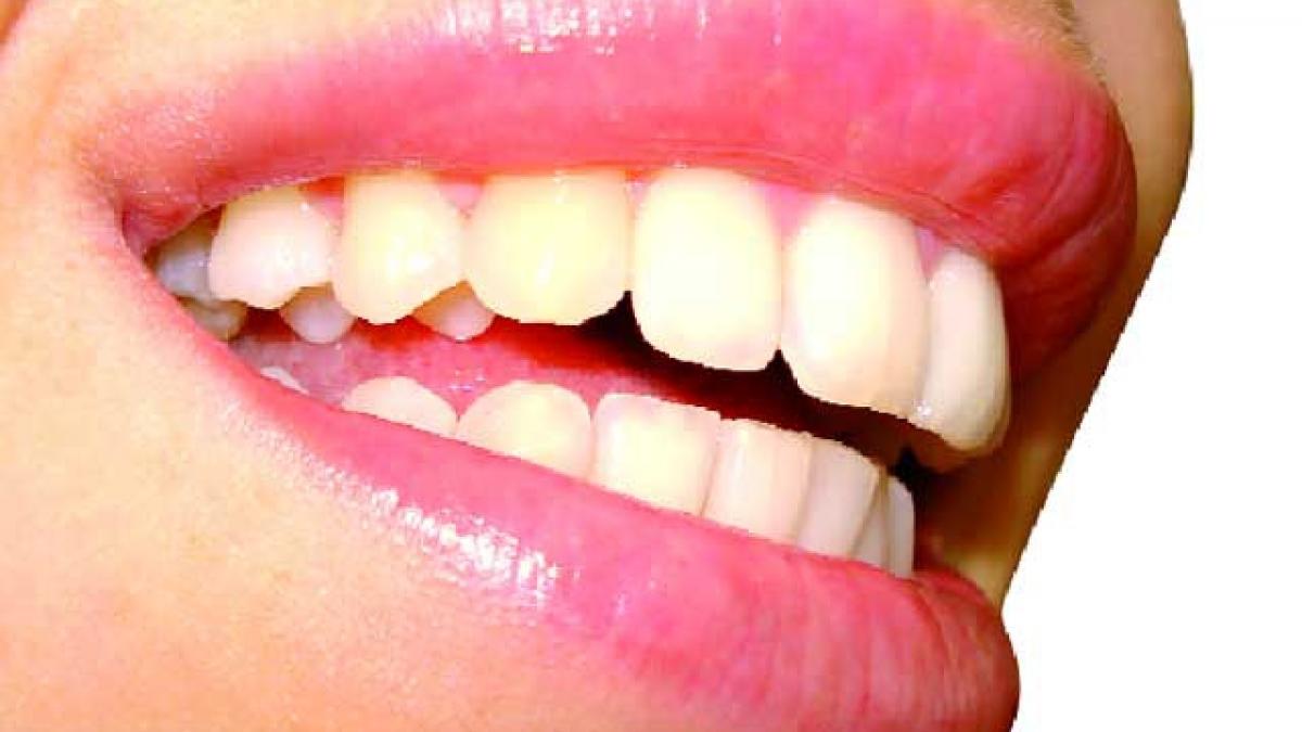 Restaurarea substanţei dentare cu pivoţi de sticlă.