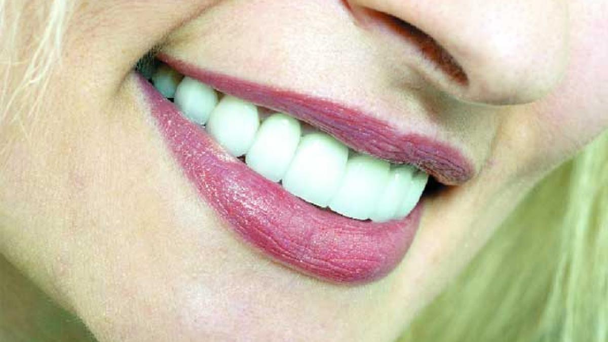 Faţetele dentare