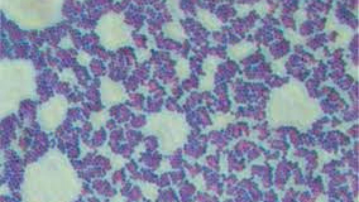Infecţiile pulmonare pot fi identificate după miros