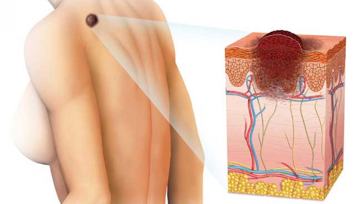 Tinerii, mai expuşi melanomului