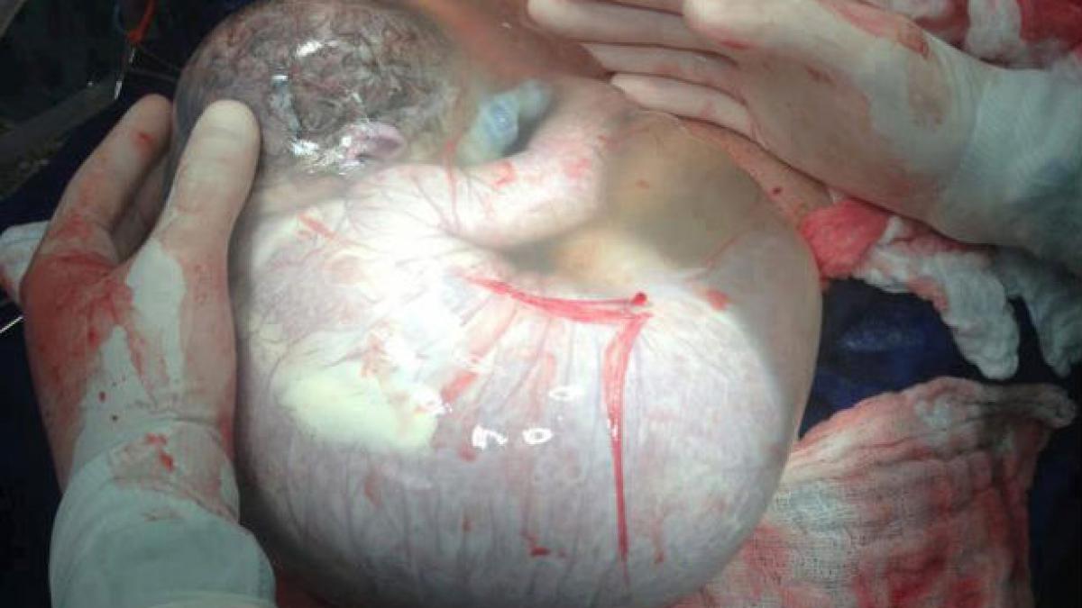 Vezi cum arată un bebeluş născut în sacul amniotic! (FOTO INCREDIBIL)