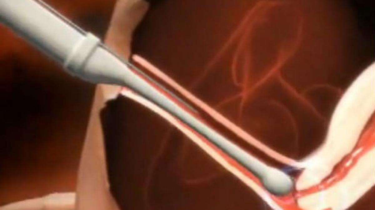 Studiu ştiinţific: una dintre metodele de fecundare in vitro poate provoca retard mintal 