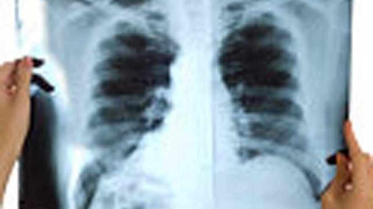 Tuberculoza – o bombă cu ceas şi forme rezistente la medicamente 