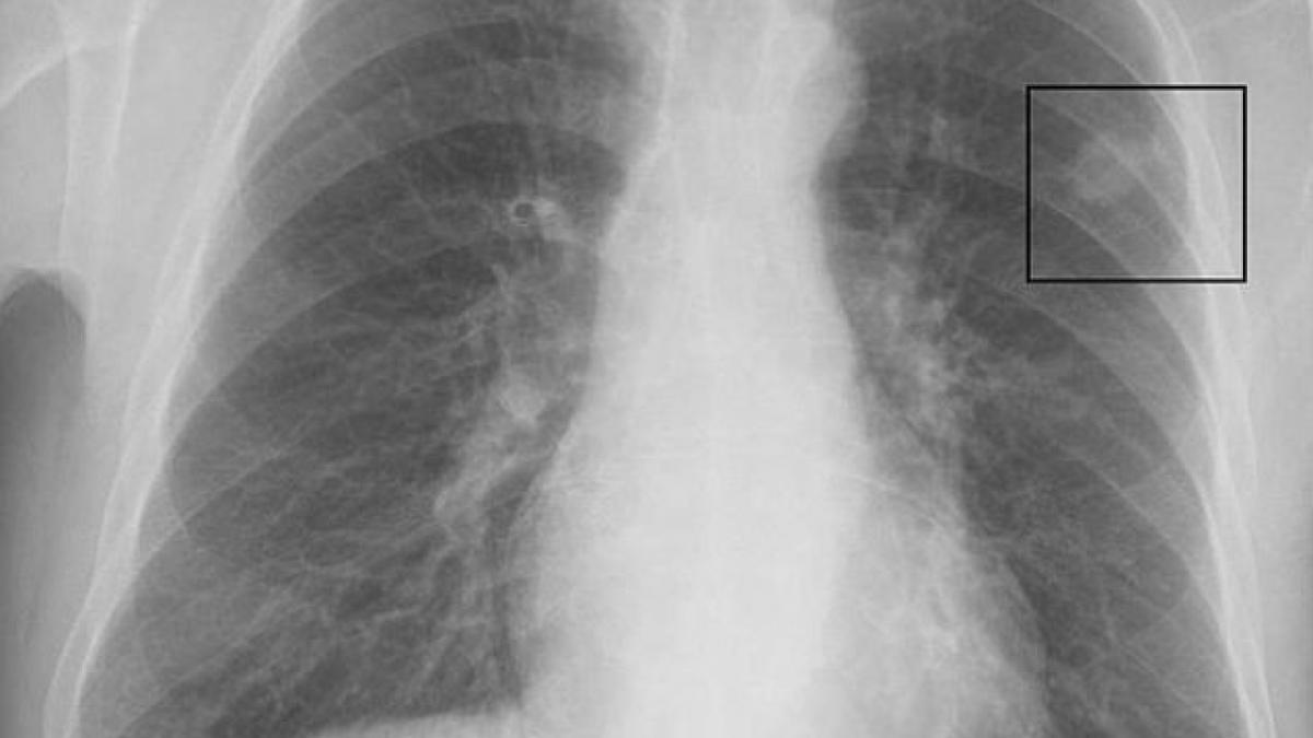 Omenirea trebuie să se aştepte la un "val tsunami" de cancer în următorii 20 de ani, avertizează Organizaţia Mondială a Sănătăţii