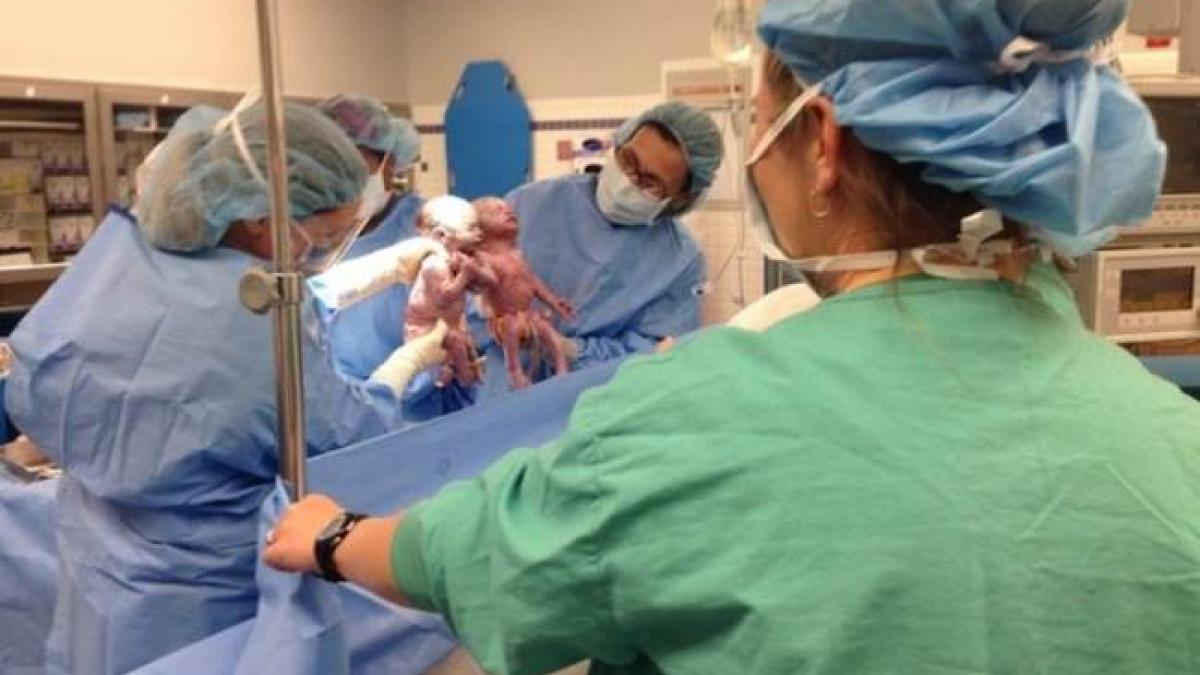 (VIDEO) Două fetiţe, gemene, diagnosticate cu o afecțiune foarte gravă, s-au născut ţinându-se de mână!