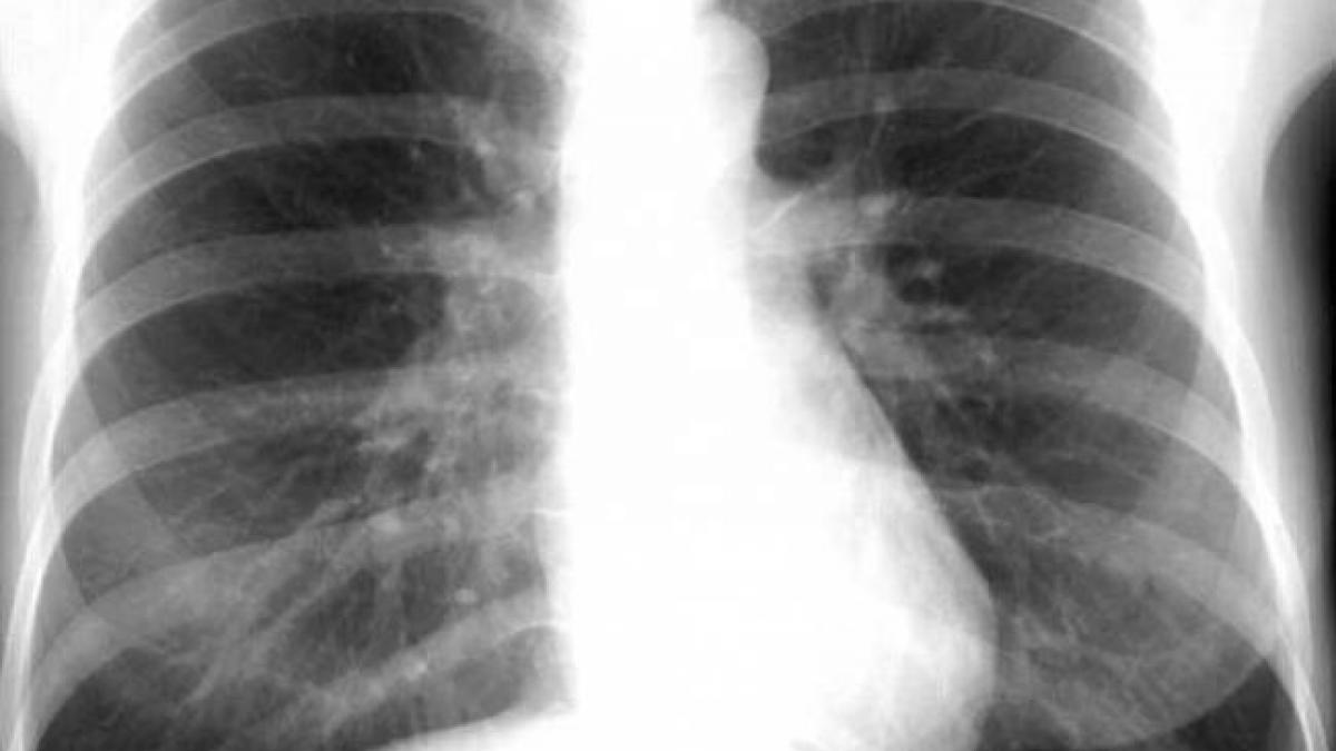Sute de copii din Constanţa, examinaţi medical după ce un profesor de înot a fost diagnosticat cu TBC