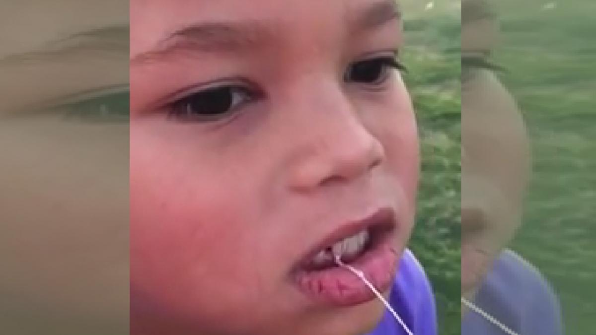 Cum se poate face o extracţie dentară cu suliţa (VIDEO)