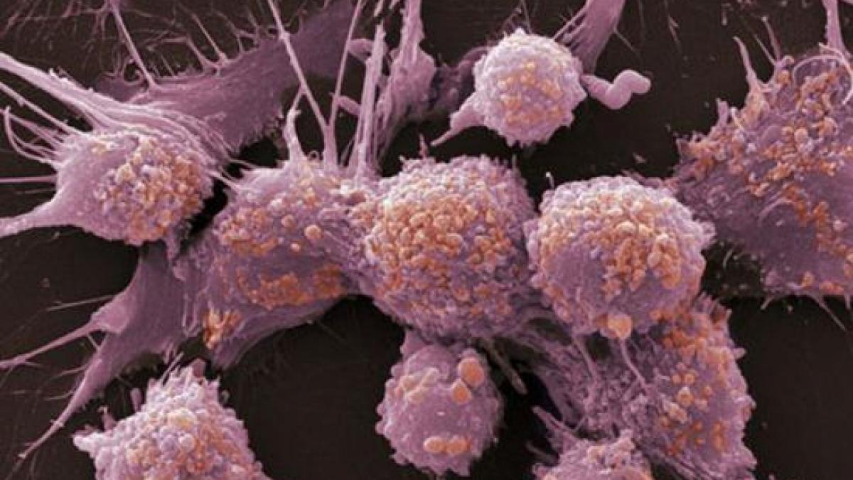 Tratament contra cancerului de piele! Doar prelungeşte viaţa, nu vindecă