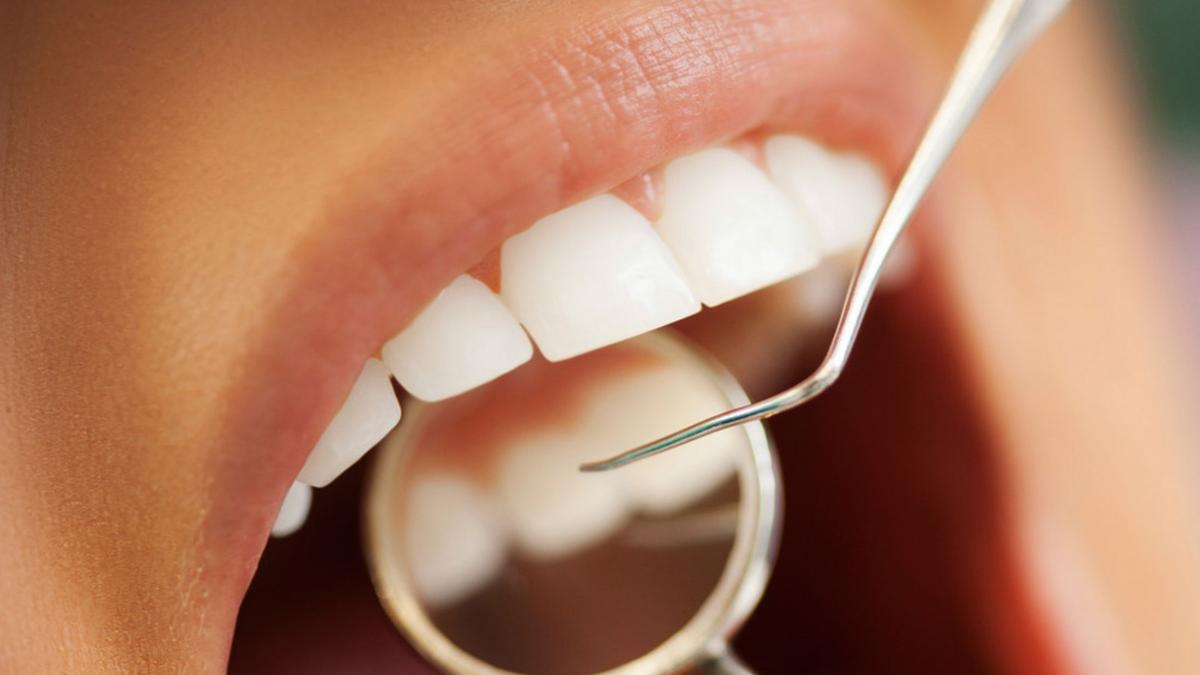 Uitați de mituri! Albirea dentară nu strică dinții