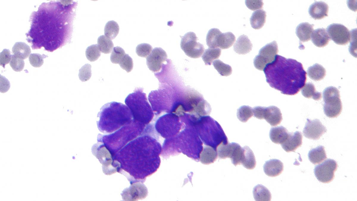 Stresul cronic, un factor important al răspândirii cancerului