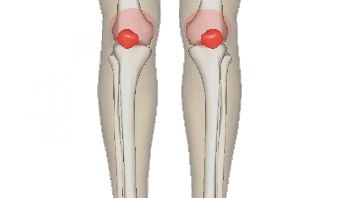 Medicii sunt uimiți. Acest tratament natural combate durerile articulare și previne osteoporoza