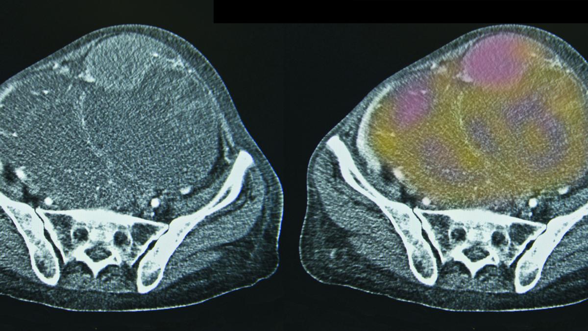 Cancerul ovarian –chestionarul prin care afli dacă riști să te îmbolnăvești