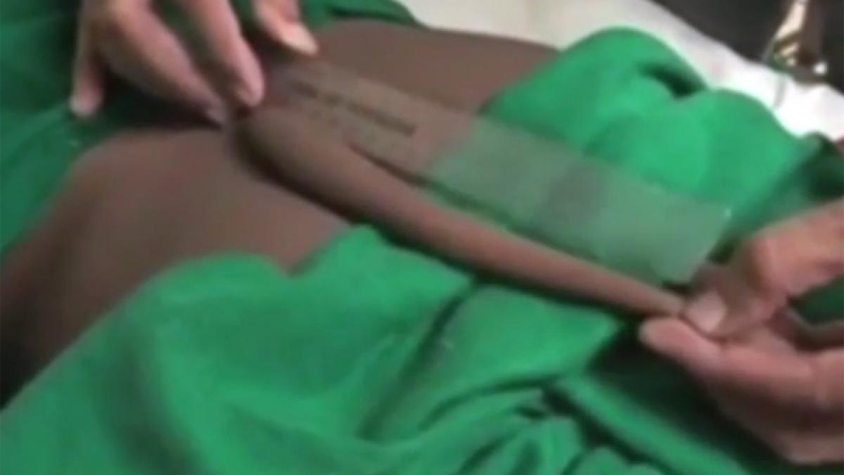video neurochirurgii indieni au trebuit sa extirpe cea mai lunga coada a unui om