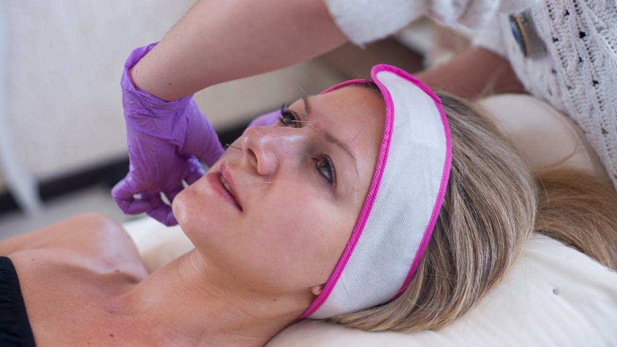 Cum scapi de riduri cu... LIFTING PRIN ACUPUNCTURĂ