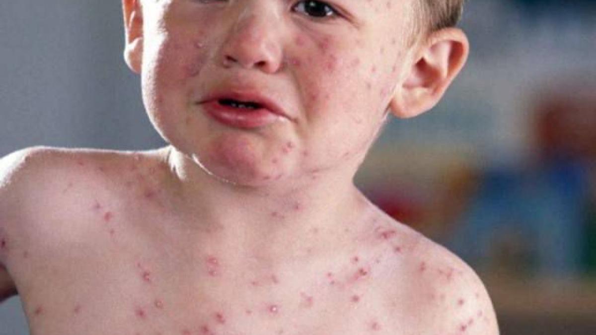 EPIDEMIE DE RUJEOLĂ în Timișoara. Spitalul de Boli Infecțioase a devenit neîncăpător