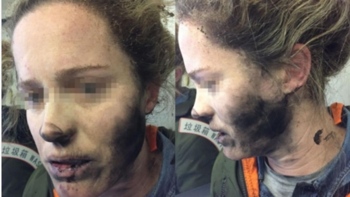O australiancă a suferit arsuri pe faţă după ce căştile i-au explodat în timpul unui zbor