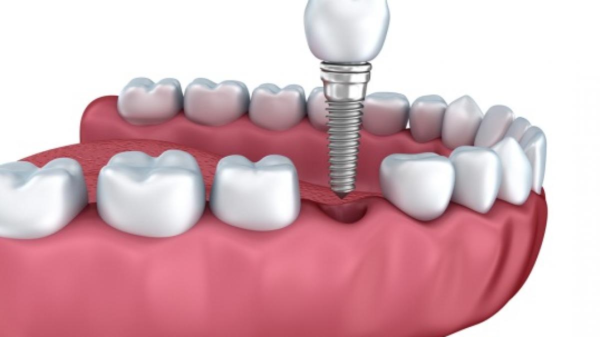 (P) Cele mai frecvente riscuri postoperatorii ale implantului dentar