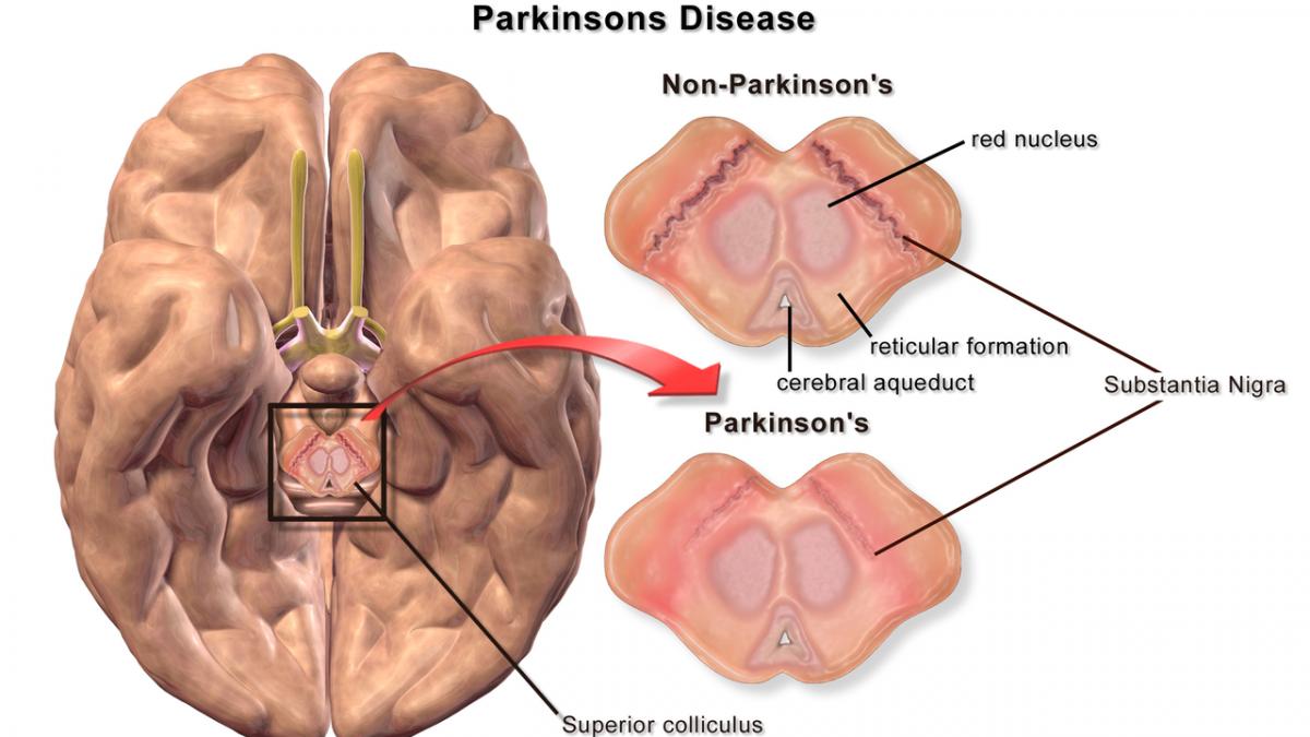 Medicament pentru diabet benefic în tratarea bolii Parkinson
