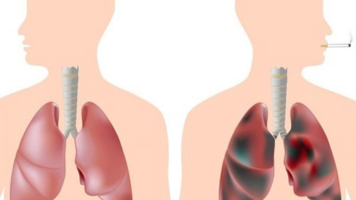 Tratamente naturiste. Elixirul pentru fumători! Remediu natural pentru curățarea plămânilor