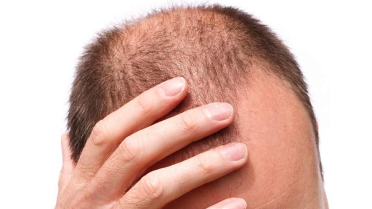 Persoanele care lucrează mult sunt predispuse să chelească 