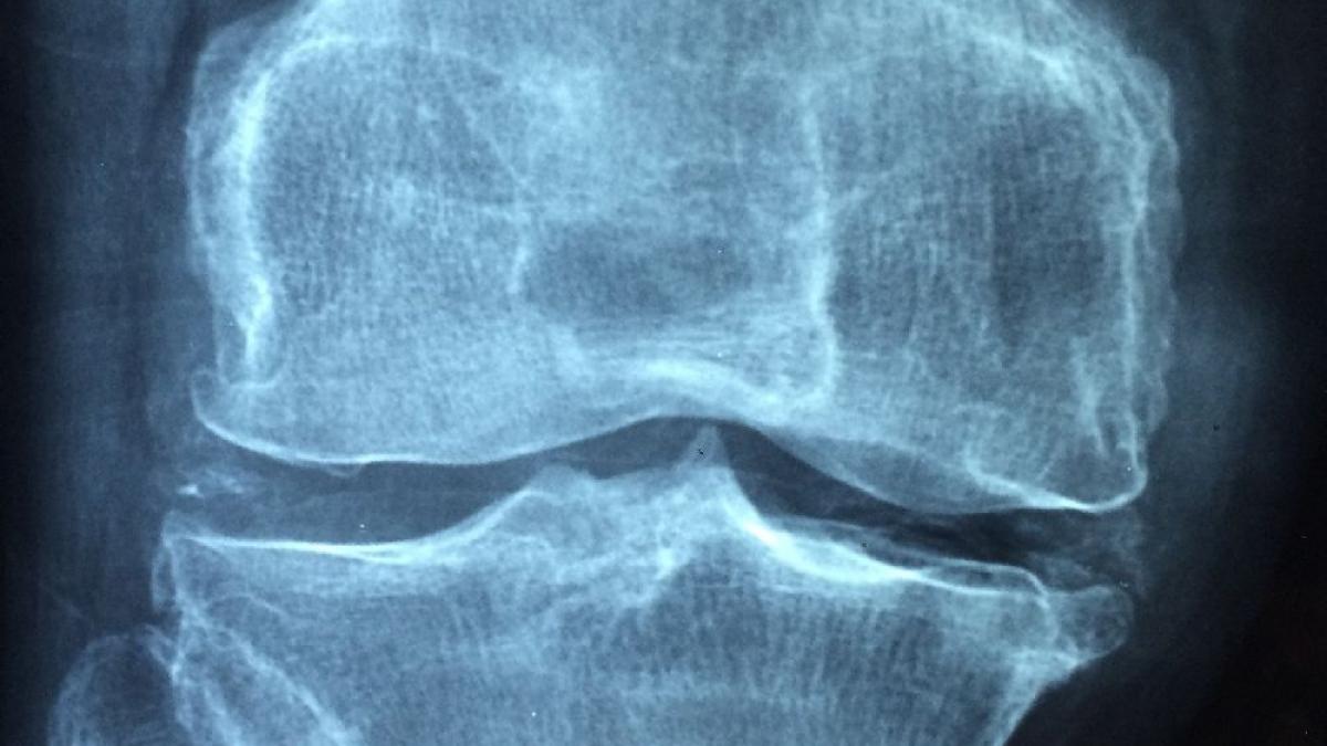 Osteoporoza e o pierdere de substanţă osoasă cu fragilizarea oaselor