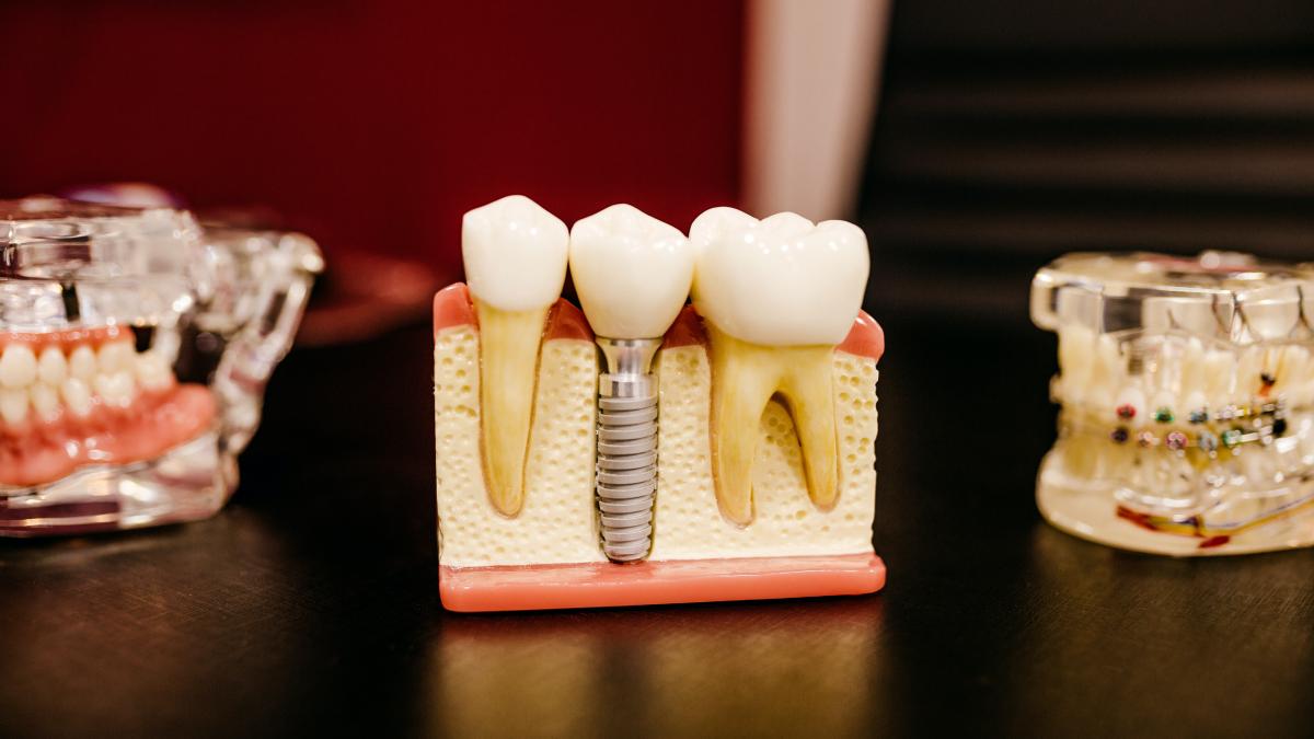 6 lucruri pe care nu le știai despre implanturile dentare