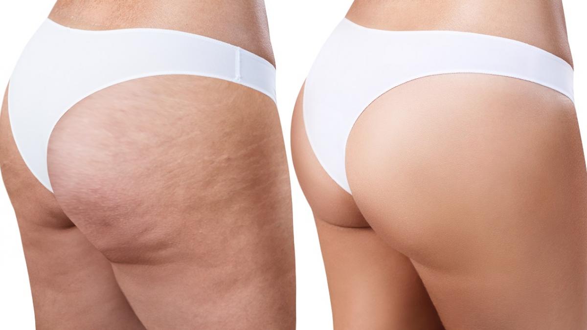 Adio, celulită! Învață cum să obții o piele fără imperfecțiuni până la vară