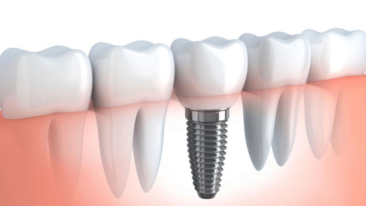 Pregătirea pentru montarea unui implant dentar