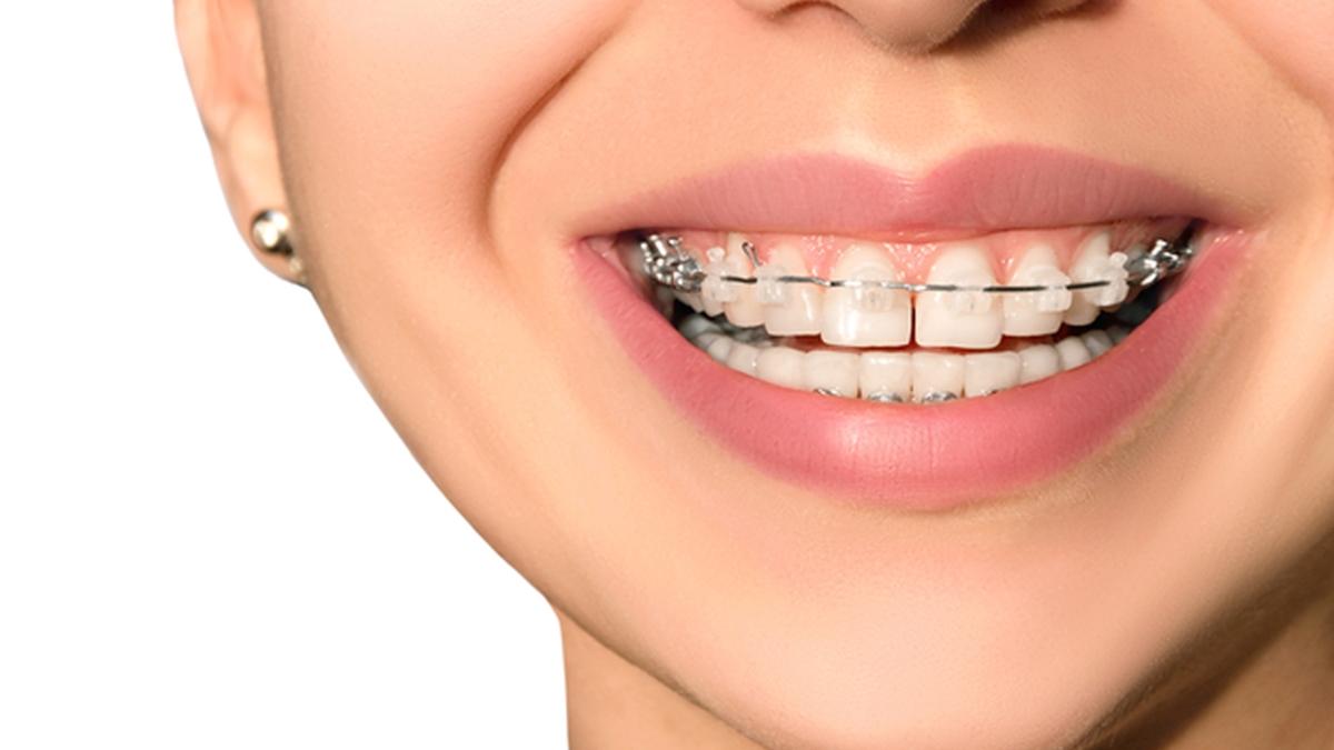 5 motive pentru care ar trebui să îți pui aparat dentar