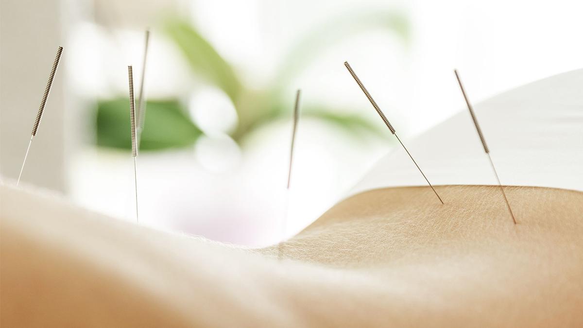 Cum putem opri durerea prin acupunctură