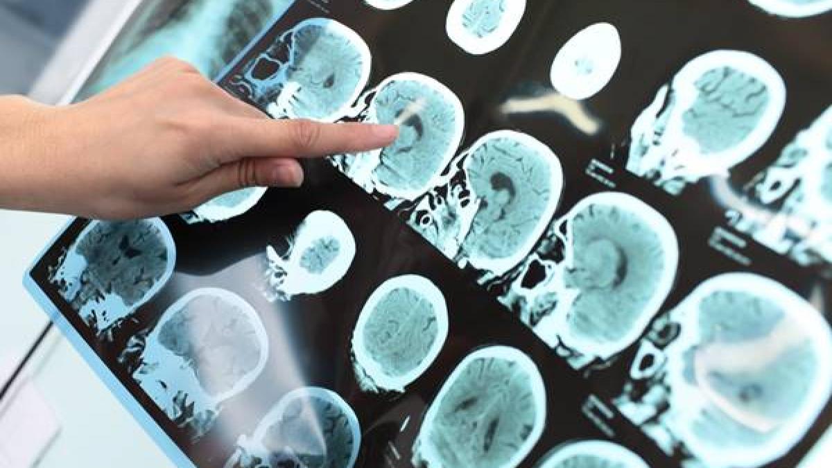 Un nou sistem de tratament pentru cancerul cerebral