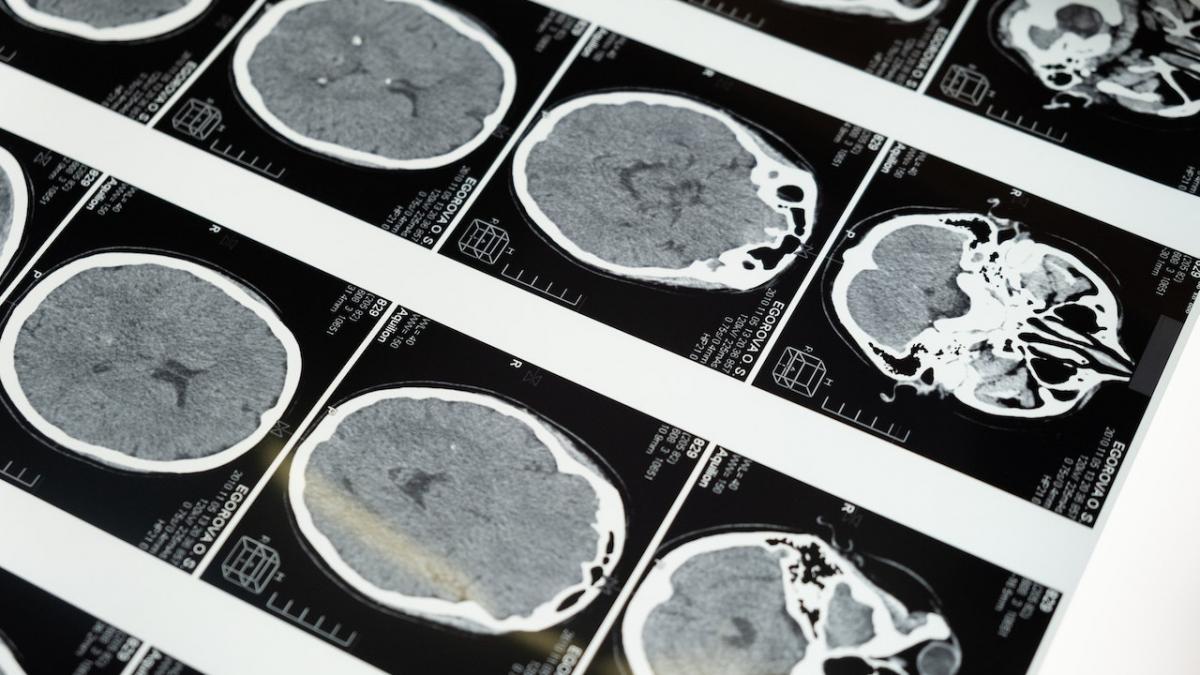 5 boli neurologice și ce trebuie să știi despre ele