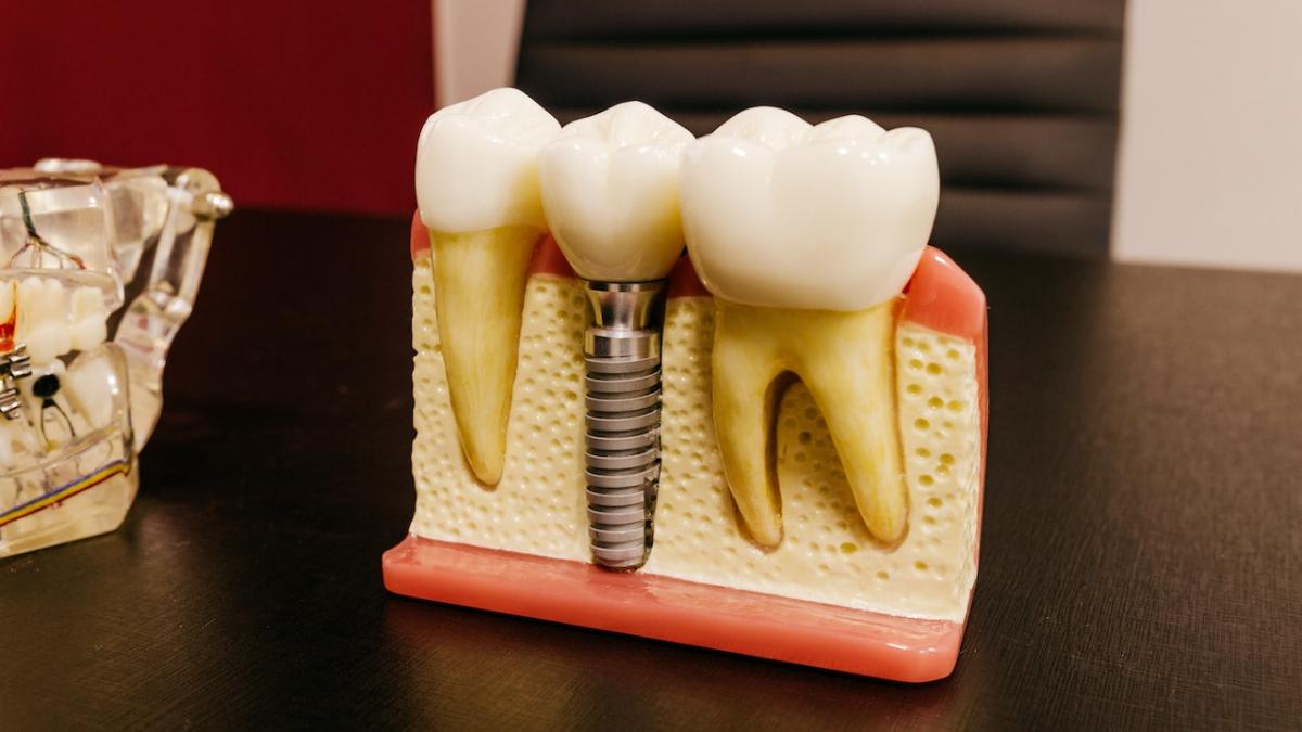 Implantul dentar - o opțiune modernă și durabilă pentru îmbunătățirea sănătății dentare