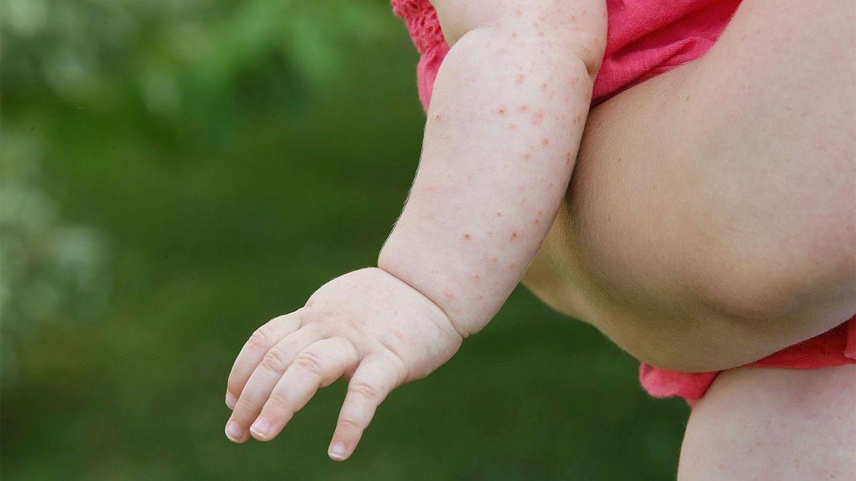 Creștere alarmantă a cazurilor de scarlatină la copii