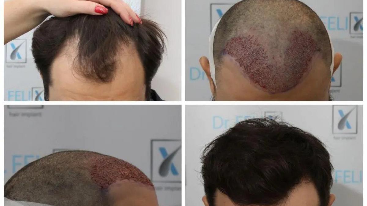 (P) Cauze comune ale căderii părului - află de implant de păr realizat la clinica Dr. Felix Hair Implant