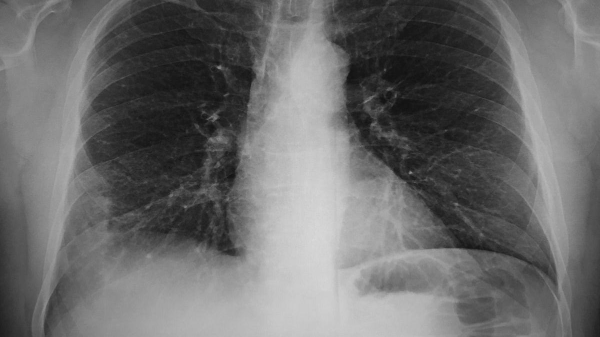 Caz unic în lumea medicală. O tânără profesoară a trăit 6 luni cu un prezervativ în plămâni