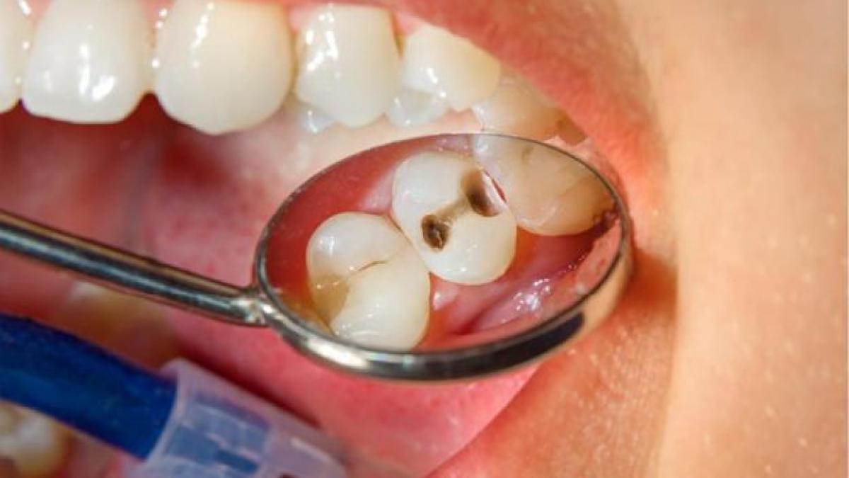 De ce apar cariile dentare si cum le poti preveni