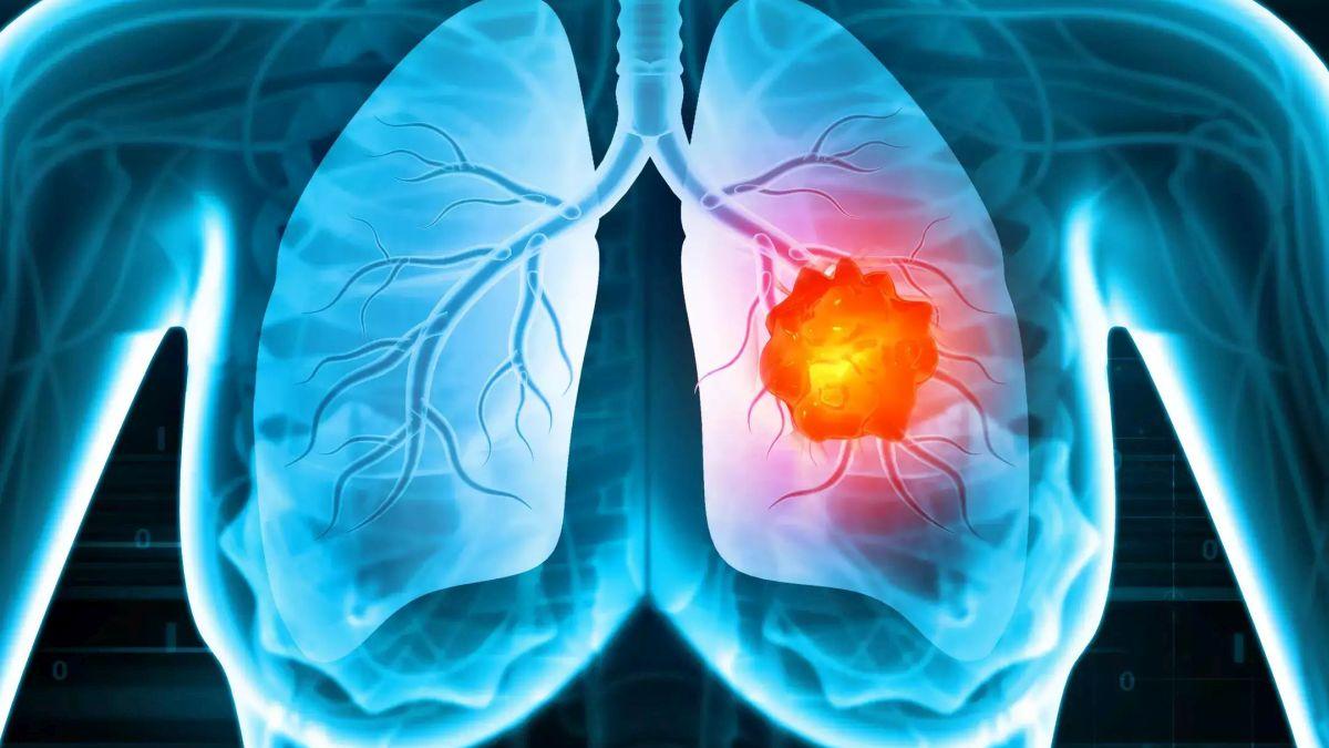 Pacienții cu cancer pulmonar se confruntă cu cel mai ridicat nivel de depresie