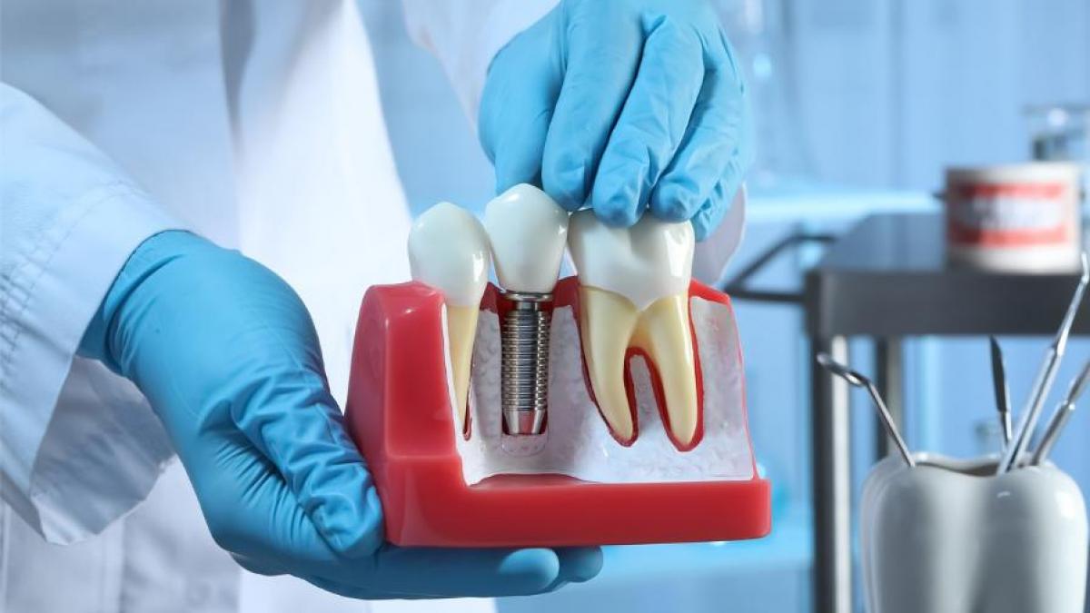 Secretul zâmbetului radiant și accesibil: implanturile dentare din titan
