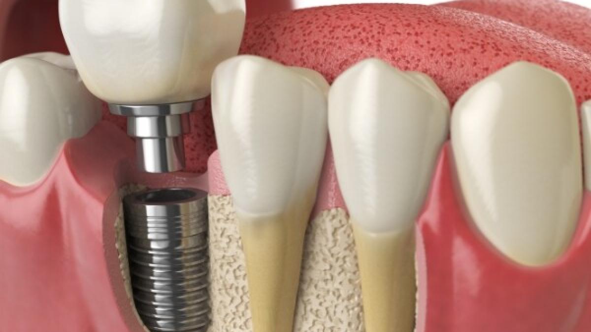 Implanturile Dentare: O Soluție Modernă pentru Sănătatea Orală