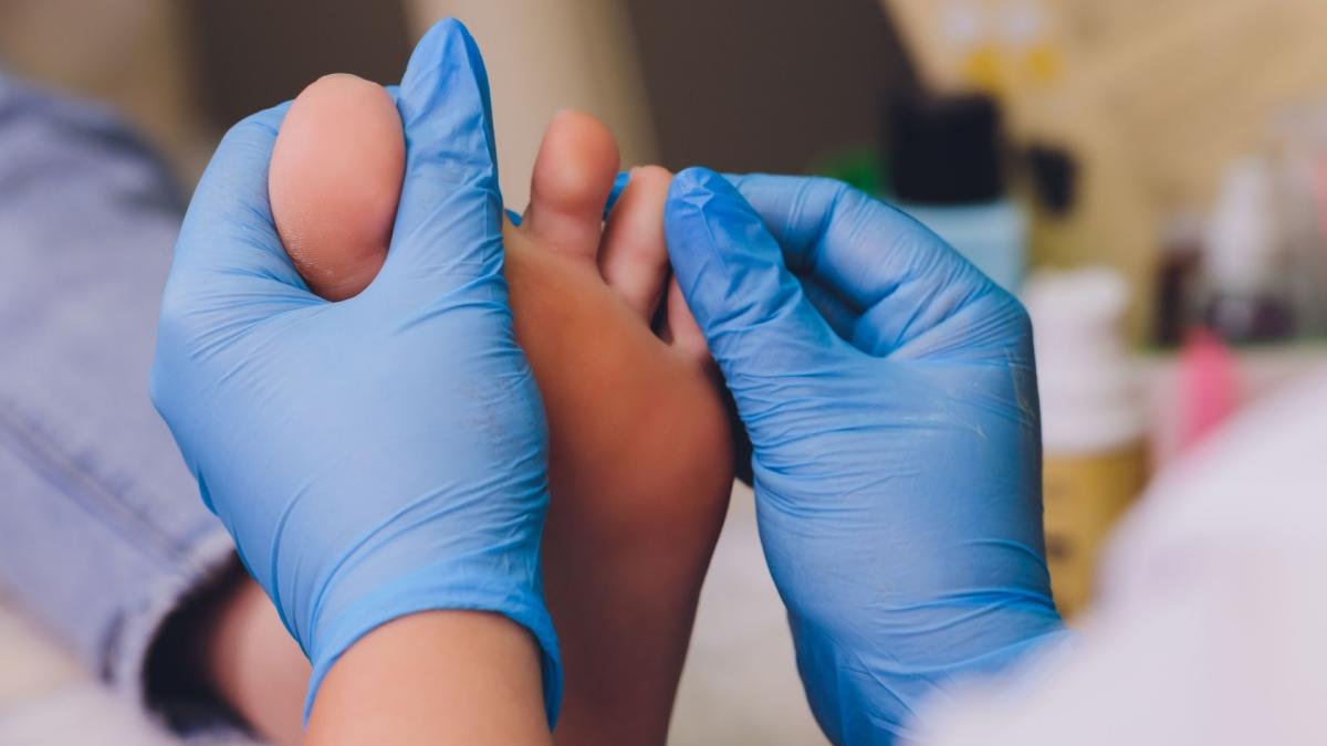 Ciuperca piciorului: cum să recunoști infecția și să o tratezi eficient