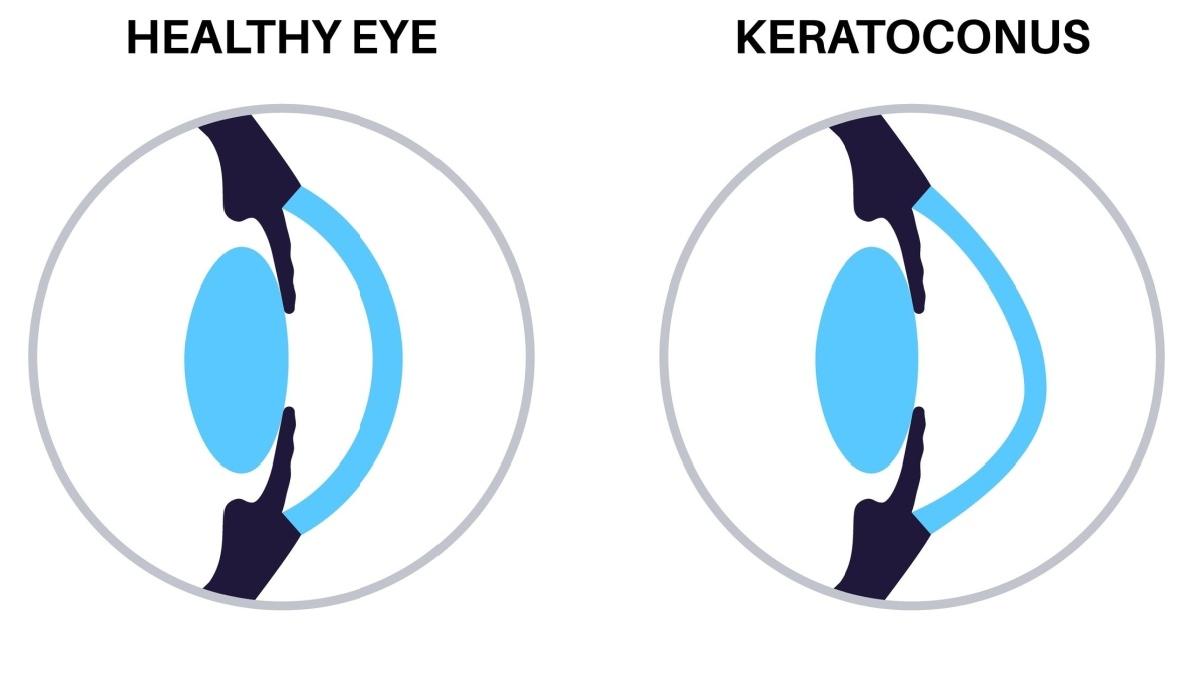 Keratoconus: cauze, simptome și opțiuni de tratament