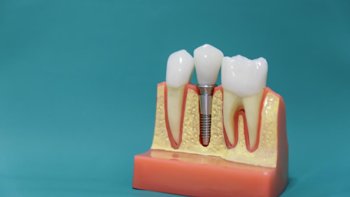 Implantul dentar, o procedură stomatologică de ultimă generaţie