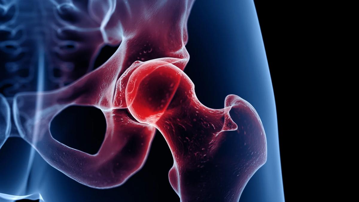 Osteoporoza, o afecțiune „silențioasă” depistată tardiv, deși este ușor de diagnosticat