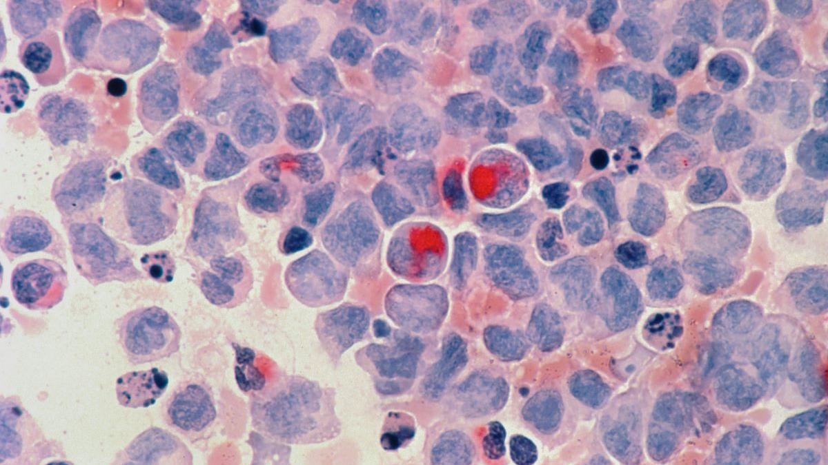 Umflătura la gât poate semnala cancer renal: Semne, factori de risc și când să mergi la medic